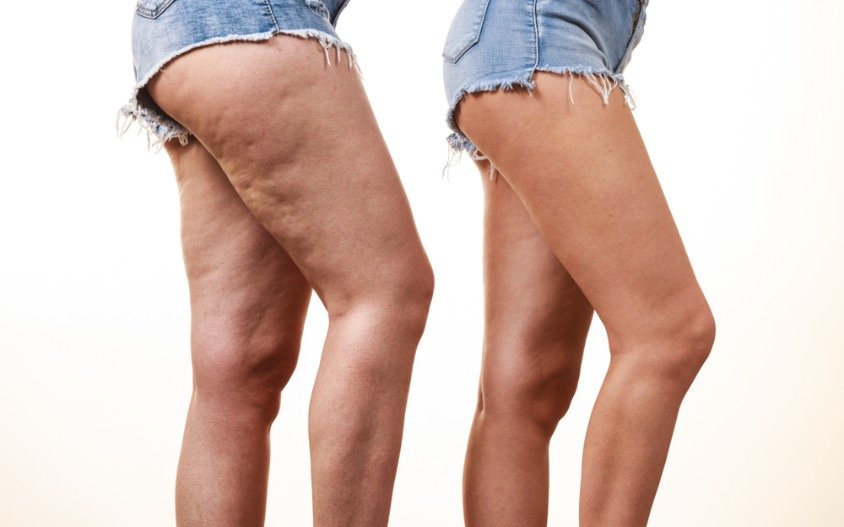 Celulitis: Mitos, causas y soluciones reales